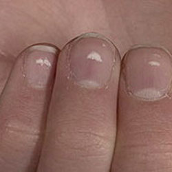 Почему появляются белые полоски и пятна на ногтях?